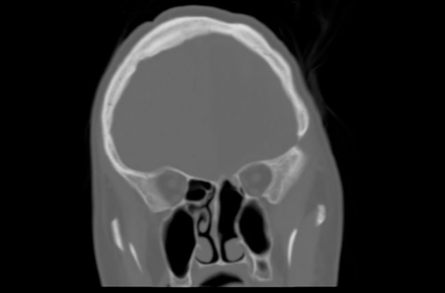 Triplanar view of defect and endoscopic vide demonstrating meningoencephalocele.
